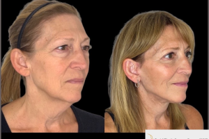 60-y.o-female-who-underwent-Deep-Plane-Facelift-Extended-Deep-plane-Neck-Lift-Upper-Blepharoplasty-Lower-Blepharoplasty-Facial-Fat-Transfer-and-CO2-laser-4