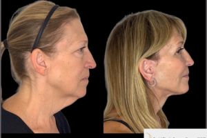 60-y.o-female-who-underwent-Deep-Plane-Facelift-Extended-Deep-plane-Neck-Lift-Upper-Blepharoplasty-Lower-Blepharoplasty-Facial-Fat-Transfer-and-CO2-laser-5