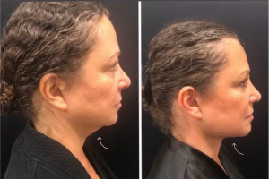 63-y.o-female-who-underwent-chin-and-neck-liposculpting-along-with-facetite-and-Morpheus-treatment-1