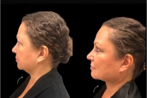 63-y.o-female-who-underwent-chin-and-neck-liposculpting-along-with-facetite-and-Morpheus-treatment-2