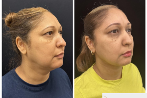 50-y.o-female-who-underwent-chin-and-neck-liposculpting-along-with-facetite-and-Morpheus-treatment-1