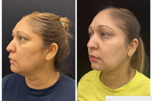 50-y.o-female-who-underwent-chin-and-neck-liposculpting-along-with-facetite-and-Morpheus-treatment-2