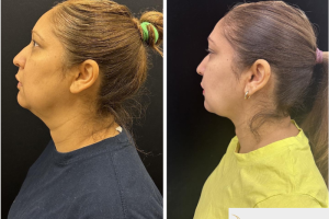50-y.o-female-who-underwent-chin-and-neck-liposculpting-along-with-facetite-and-Morpheus-treatment-3