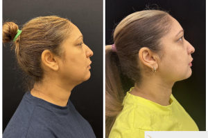 50-y.o-female-who-underwent-chin-and-neck-liposculpting-along-with-facetite-and-Morpheus-treatment-4