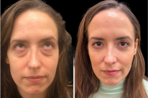 33-y.o-female-underwent-transconj-no-visible-scar-lower-blepharoplasty-along-with-facial-fat-transfer-1