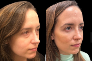 33-y.o-female-underwent-transconj-no-visible-scar-lower-blepharoplasty-along-with-facial-fat-transfer-2