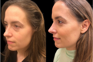 33-y.o-female-underwent-transconj-no-visible-scar-lower-blepharoplasty-along-with-facial-fat-transfer-3