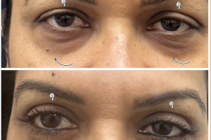 underwent-transconj-no-visible-scar-lower-blepharoplasty-and-upper-blepharoplasty-1