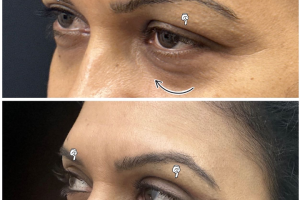 underwent-transconj-no-visible-scar-lower-blepharoplasty-and-upper-blepharoplasty-2