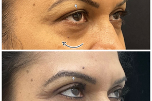 underwent-transconj-no-visible-scar-lower-blepharoplasty-and-upper-blepharoplasty-3