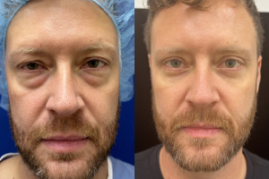 40-male-3-months-after-upper-and-lower-bleph-1-1
