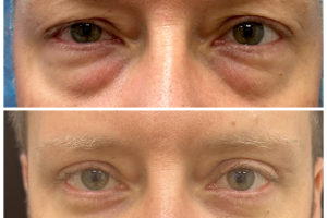40yo-underwent-transconj-no-visible-scar-lower-blepharoplasty-and-upper-blepharoplasty-1