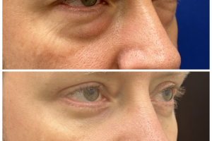 40yo-underwent-transconj-no-visible-scar-lower-blepharoplasty-and-upper-blepharoplasty-2