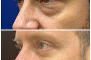40yo-underwent-transconj-no-visible-scar-lower-blepharoplasty-and-upper-blepharoplasty-3