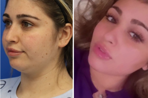 26-yo-female-underwent-facial-slimming-surgery-which-entails-buccal-fat-reduction-and-chin-and-neck-liposculpting