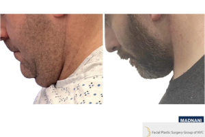42-y.o-male-underwent-Awake-Deep-plane-Facelift-Extended-Necklift-1