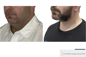 42-y.o-male-underwent-Awake-Deep-plane-Facelift-Extended-Necklift-2