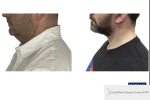42-y.o-male-underwent-Awake-Deep-plane-Facelift-Extended-Necklift-3