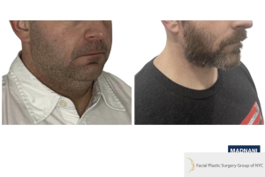 42-y.o-male-underwent-Awake-Deep-plane-Facelift-Extended-Necklift-4