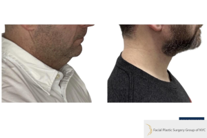 42-y.o-male-underwent-Awake-Deep-plane-Facelift-Extended-Necklift-5