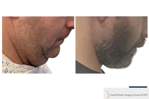 42-y.o-male-underwent-Awake-Deep-plane-Facelift-Extended-Necklift-6