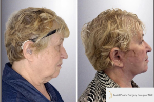 Deep-Plane-Facelift-Extended-Deep-plane-Neck-Lift-Upper-Blepharoplasty-Lower-Blepharoplasty-Facial-Fat-Transfer-and-CO2-laser-1