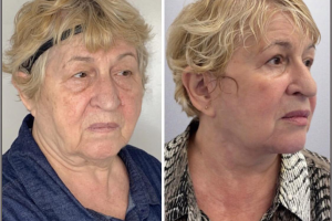 Deep-Plane-Facelift-Extended-Deep-plane-Neck-Lift-Upper-Blepharoplasty-Lower-Blepharoplasty-Facial-Fat-Transfer-and-CO2-laser-2