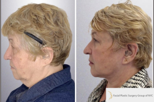 Deep-Plane-Facelift-Extended-Deep-plane-Neck-Lift-Upper-Blepharoplasty-Lower-Blepharoplasty-Facial-Fat-Transfer-and-CO2-laser-3