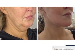 46-y.o-female-underwent-Awake-Deep-plane-Facelift-Extended-Necklift-and-Buccal-Fat-Removal-1