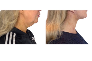 46-y.o-female-underwent-Awake-Deep-plane-Facelift-Extended-Necklift-and-Buccal-Fat-Removal-2