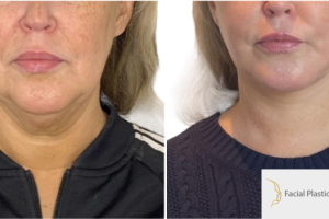 46-y.o-female-underwent-Awake-Deep-plane-Facelift-Extended-Necklift-and-Buccal-Fat-Removal-3