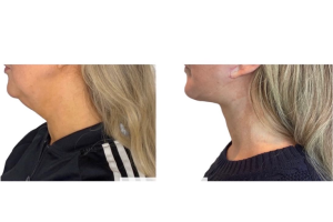 46-y.o-female-underwent-Awake-Deep-plane-Facelift-Extended-Necklift-and-Buccal-Fat-Removal-4