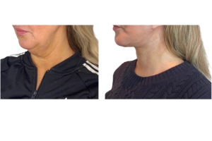 46-y.o-female-underwent-Awake-Deep-plane-Facelift-Extended-Necklift-and-Buccal-Fat-Removal-5
