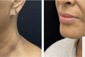 56-y.o-female-underwent-Awake-Deep-plane-Facelift-Extended-Necklift-and-Buccal-Fat-Removal-1