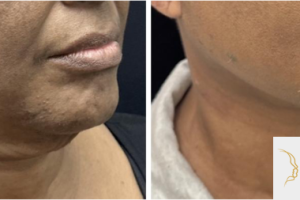 56-y.o-female-underwent-Awake-Deep-plane-Facelift-Extended-Necklift-and-Buccal-Fat-Removal-2