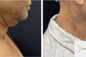 56-y.o-female-underwent-Awake-Deep-plane-Facelift-Extended-Necklift-and-Buccal-Fat-Removal-3