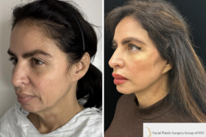 50-y.o-female-underwent-Awake-Deep-plane-Facelift-Extended-Necklift-and-Buccal-Fat-Removal-1