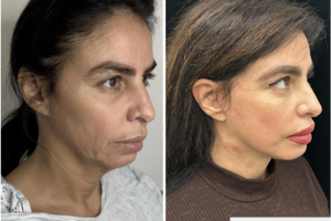 50-y.o-female-underwent-Awake-Deep-plane-Facelift-Extended-Necklift-and-Buccal-Fat-Removal-2