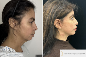50-y.o-female-underwent-Awake-Deep-plane-Facelift-Extended-Necklift-and-Buccal-Fat-Removal-3