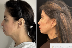 50-y.o-female-underwent-Awake-Deep-plane-Facelift-Extended-Necklift-and-Buccal-Fat-Removal-4