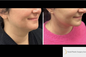 36-y.o-female-extended-neck-lift-1