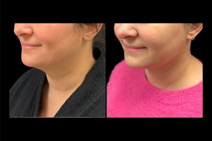 36-y.o-female-extended-neck-lift-2