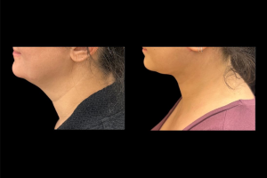 36-y.o-female-extended-neck-lift-3