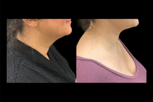 36-y.o-female-extended-neck-lift-4
