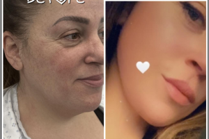 48-yo-female-underwent-Awake-Deep-plane-Facelift-Extended-Necklift-and-Buccal-Fat-Removal-1