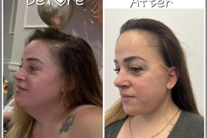 48-yo-female-underwent-Awake-Deep-plane-Facelift-Extended-Necklift-and-Buccal-Fat-Removal-3