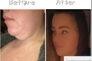 48-yo-female-underwent-Awake-Deep-plane-Facelift-Extended-Necklift-and-Buccal-Fat-Removal-4