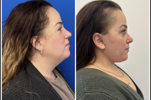 48-yo-female-underwent-Awake-Deep-plane-Facelift-Extended-Necklift-and-Buccal-Fat-Removal-5
