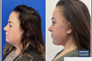 48-yo-female-underwent-Awake-Deep-plane-Facelift-Extended-Necklift-and-Buccal-Fat-Removal-6