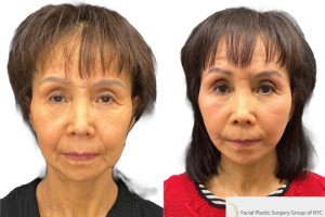 64-yo-female-underwent-Awake-Deep-plane-Facelift-Extended-Necklift-2